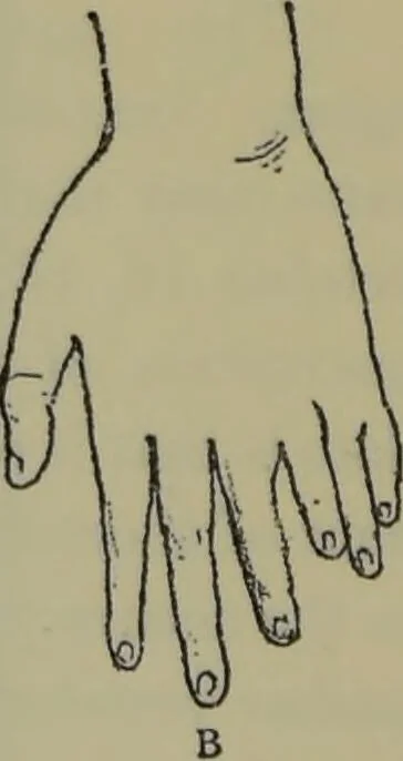 An illustration from Anomalies and curiosities of medicine : being an encyclopedic collection of rare and extraordinary cases, and of the most striking instances of abnormality in all branches of medicine and surgery, derived from an exhaustive research of medical literature from its origin to the present day / abstracted, classified, annotated, and indexed, by George M. Gould and Walter L. Pyle ; with 295 illustrations in the text, and 12 half-tone and colored plates., 1897, leaf 284