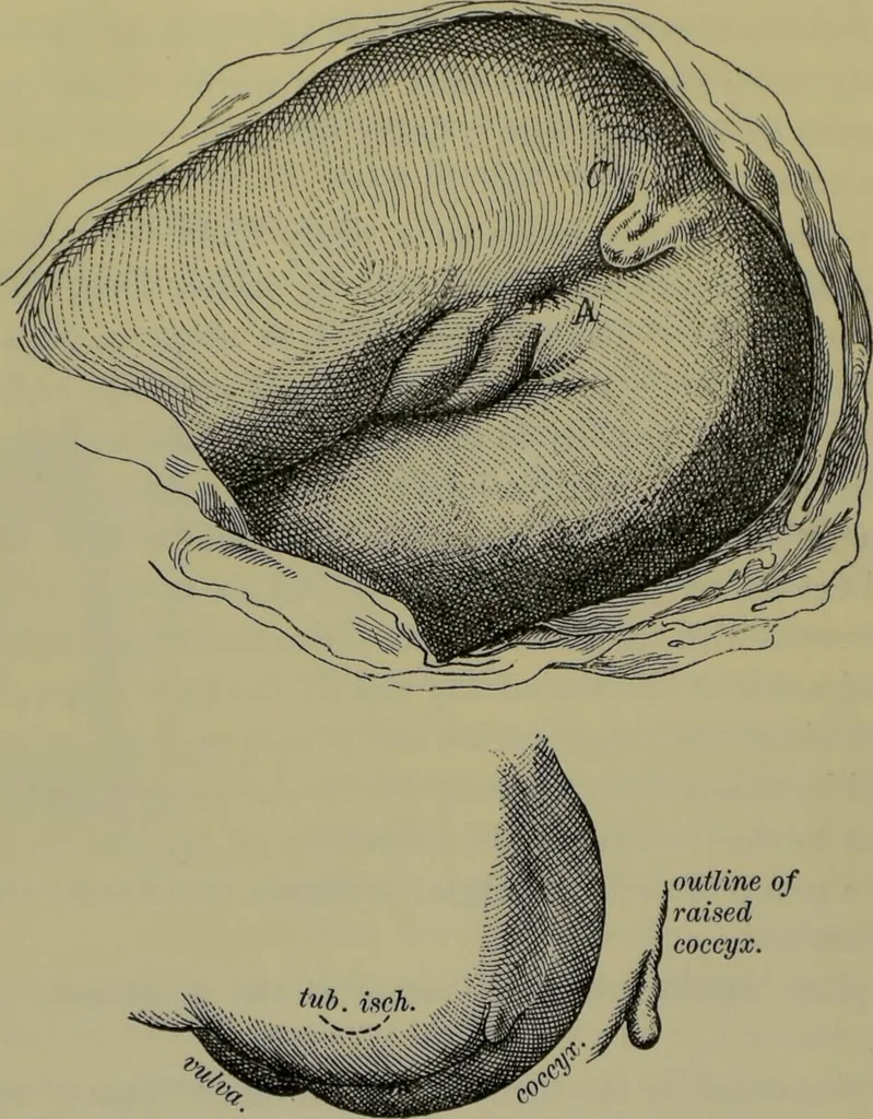 An illustration from Anomalies and curiosities of medicine : being an encyclopedic collection of rare and extraordinary cases, and of the most striking instances of abnormality in all branches of medicine and surgery, derived from an exhaustive research of medical literature from its origin to the present day / abstracted, classified, annotated, and indexed, by George M. Gould and Walter L. Pyle ; with 295 illustrations in the text, and 12 half-tone and colored plates., 1897, leaf 290