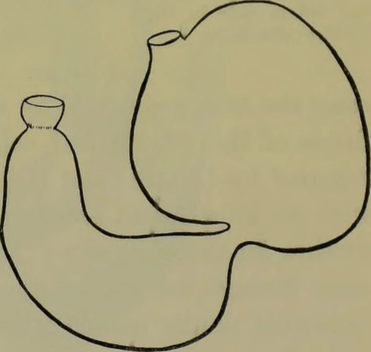 An illustration from Anomalies and curiosities of medicine : being an encyclopedic collection of rare and extraordinary cases, and of the most striking instances of abnormality in all branches of medicine and surgery, derived from an exhaustive research of medical literature from its origin to the present day / abstracted, classified, annotated, and indexed, by George M. Gould and Walter L. Pyle ; with 295 illustrations in the text, and 12 half-tone and colored plates., 1897, leaf 297
