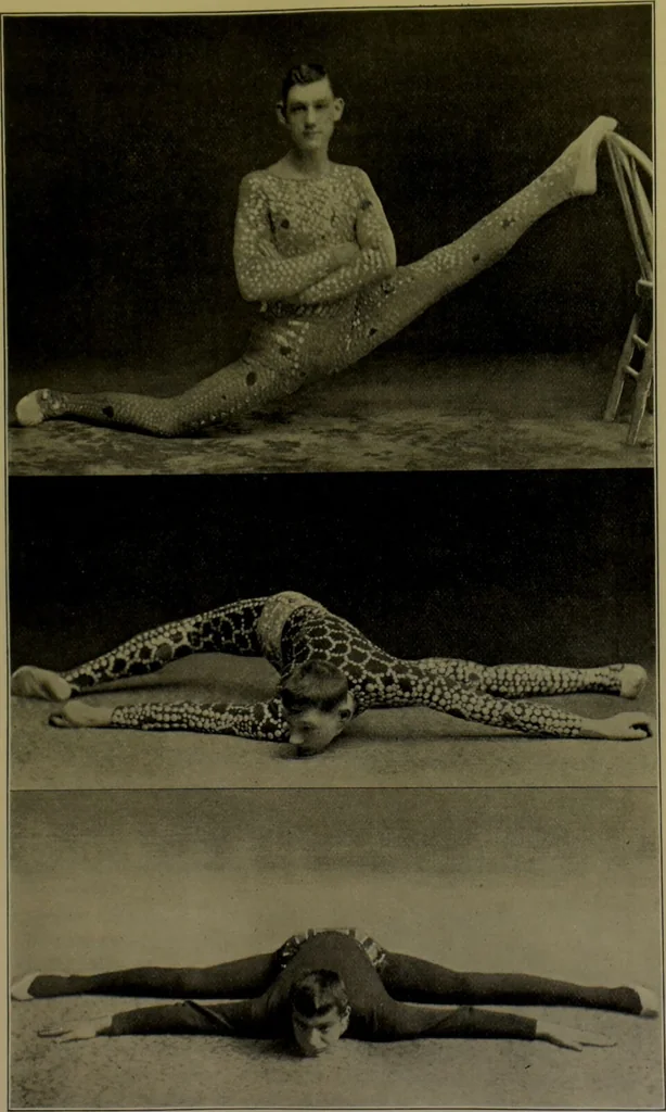 An illustration from Anomalies and curiosities of medicine : being an encyclopedic collection of rare and extraordinary cases, and of the most striking instances of abnormality in all branches of medicine and surgery, derived from an exhaustive research of medical literature from its origin to the present day / abstracted, classified, annotated, and indexed, by George M. Gould and Walter L. Pyle ; with 295 illustrations in the text, and 12 half-tone and colored plates., 1897, leaf 483