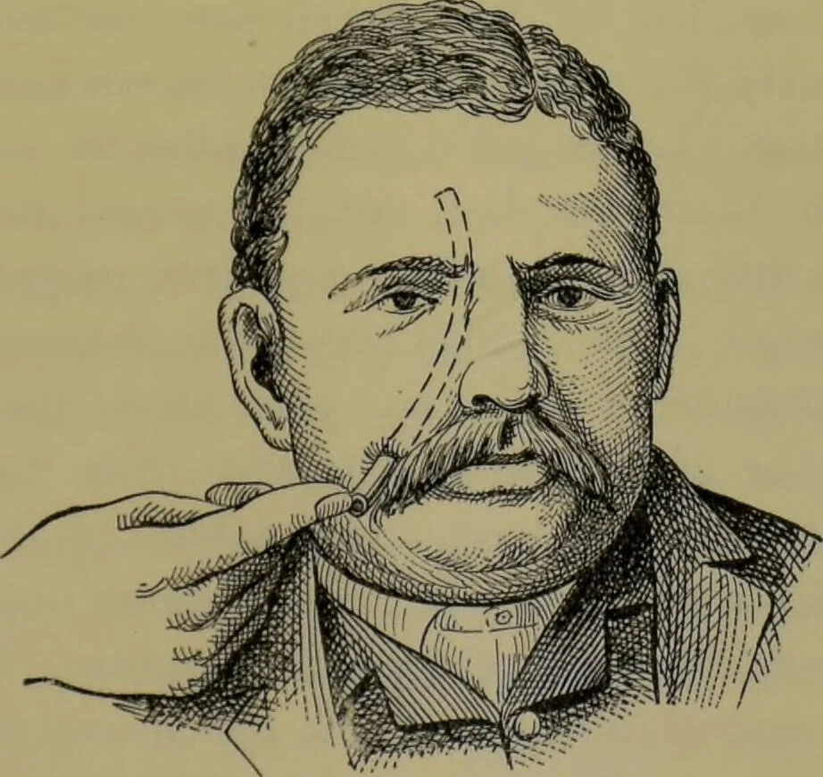 An illustration from Anomalies and curiosities of medicine : being an encyclopedic collection of rare and extraordinary cases, and of the most striking instances of abnormality in all branches of medicine and surgery, derived from an exhaustive research of medical literature from its origin to the present day / abstracted, classified, annotated, and indexed, by George M. Gould and Walter L. Pyle ; with 295 illustrations in the text, and 12 half-tone and colored plates., 1897, leaf 559