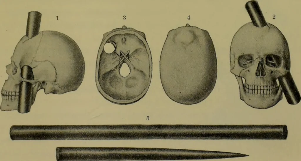An illustration from Anomalies and curiosities of medicine : being an encyclopedic collection of rare and extraordinary cases, and of the most striking instances of abnormality in all branches of medicine and surgery, derived from an exhaustive research of medical literature from its origin to the present day / abstracted, classified, annotated, and indexed, by George M. Gould and Walter L. Pyle ; with 295 illustrations in the text, and 12 half-tone and colored plates., 1897, leaf 565