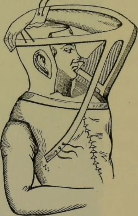 An illustration from Anomalies and curiosities of medicine : being an encyclopedic collection of rare and extraordinary cases, and of the most striking instances of abnormality in all branches of medicine and surgery, derived from an exhaustive research of medical literature from its origin to the present day / abstracted, classified, annotated, and indexed, by George M. Gould and Walter L. Pyle ; with 295 illustrations in the text, and 12 half-tone and colored plates., 1897, leaf 573