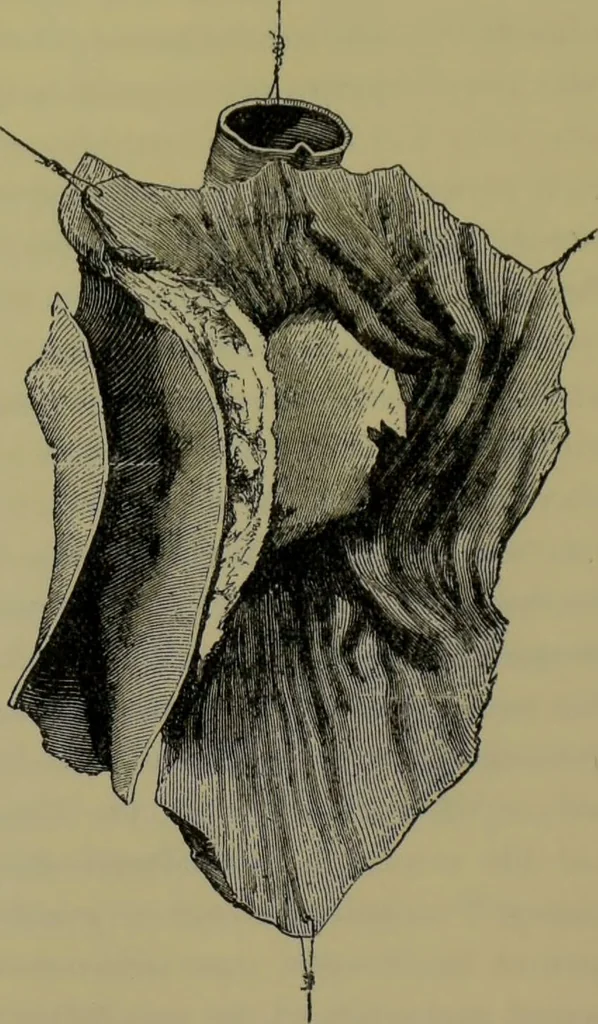 An illustration from Anomalies and curiosities of medicine : being an encyclopedic collection of rare and extraordinary cases, and of the most striking instances of abnormality in all branches of medicine and surgery, derived from an exhaustive research of medical literature from its origin to the present day / abstracted, classified, annotated, and indexed, by George M. Gould and Walter L. Pyle ; with 295 illustrations in the text, and 12 half-tone and colored plates., 1897, leaf 585