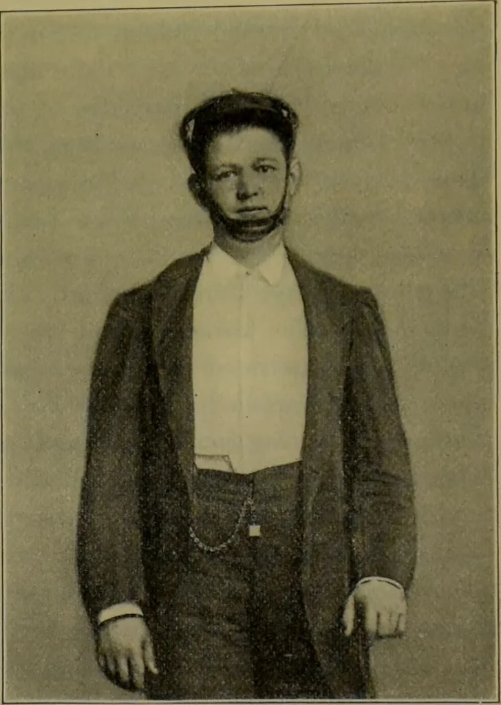 An illustration from Anomalies and curiosities of medicine : being an encyclopedic collection of rare and extraordinary cases, and of the most striking instances of abnormality in all branches of medicine and surgery, derived from an exhaustive research of medical literature from its origin to the present day / abstracted, classified, annotated, and indexed, by George M. Gould and Walter L. Pyle ; with 295 illustrations in the text, and 12 half-tone and colored plates., 1897, leaf 591