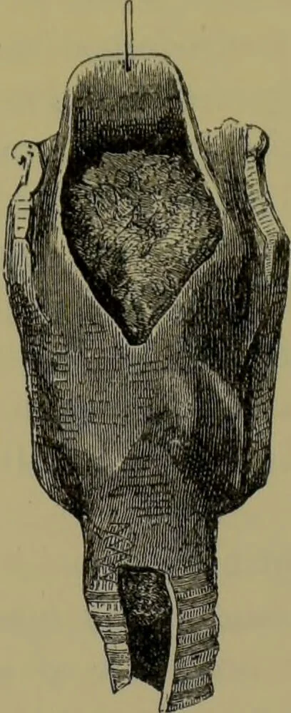 An illustration from Anomalies and curiosities of medicine : being an encyclopedic collection of rare and extraordinary cases, and of the most striking instances of abnormality in all branches of medicine and surgery, derived from an exhaustive research of medical literature from its origin to the present day / abstracted, classified, annotated, and indexed, by George M. Gould and Walter L. Pyle ; with 295 illustrations in the text, and 12 half-tone and colored plates., 1897, leaf 595