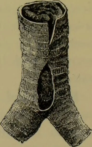 An illustration from Anomalies and curiosities of medicine : being an encyclopedic collection of rare and extraordinary cases, and of the most striking instances of abnormality in all branches of medicine and surgery, derived from an exhaustive research of medical literature from its origin to the present day / abstracted, classified, annotated, and indexed, by George M. Gould and Walter L. Pyle ; with 295 illustrations in the text, and 12 half-tone and colored plates., 1897, leaf 595