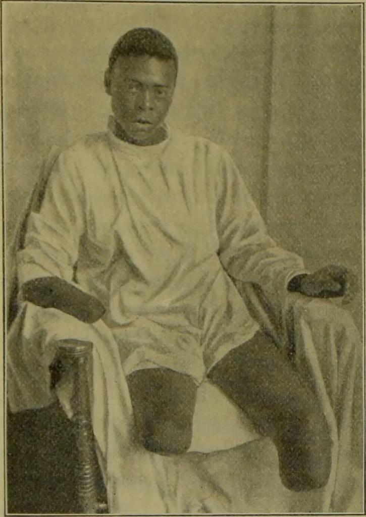 An illustration from Anomalies and curiosities of medicine : being an encyclopedic collection of rare and extraordinary cases, and of the most striking instances of abnormality in all branches of medicine and surgery, derived from an exhaustive research of medical literature from its origin to the present day / abstracted, classified, annotated, and indexed, by George M. Gould and Walter L. Pyle ; with 295 illustrations in the text, and 12 half-tone and colored plates., 1897, leaf 610