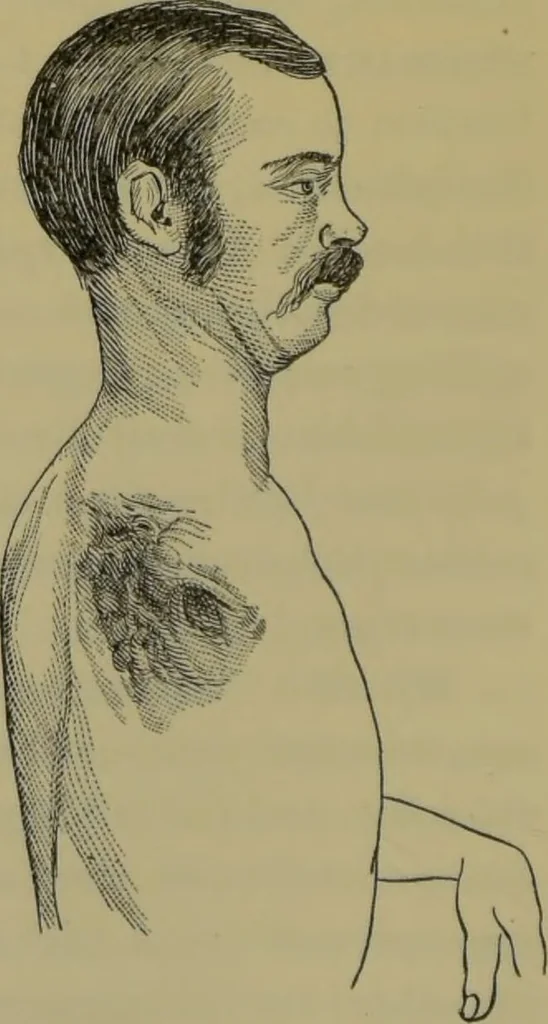 An illustration from Anomalies and curiosities of medicine : being an encyclopedic collection of rare and extraordinary cases, and of the most striking instances of abnormality in all branches of medicine and surgery, derived from an exhaustive research of medical literature from its origin to the present day / abstracted, classified, annotated, and indexed, by George M. Gould and Walter L. Pyle ; with 295 illustrations in the text, and 12 half-tone and colored plates., 1897, leaf 610