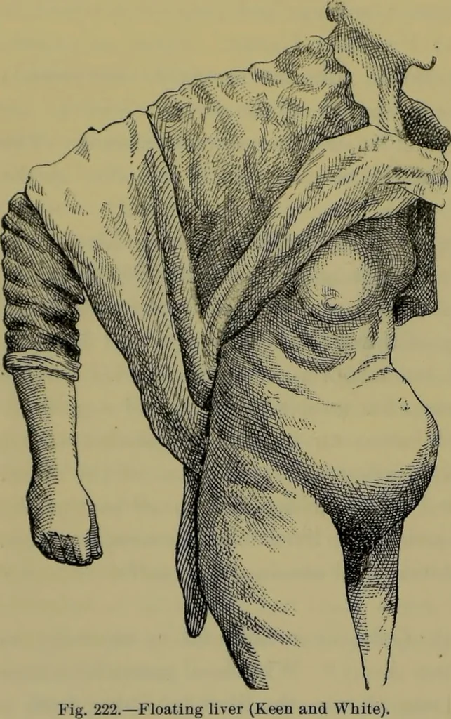 An illustration from Anomalies and curiosities of medicine : being an encyclopedic collection of rare and extraordinary cases, and of the most striking instances of abnormality in all branches of medicine and surgery, derived from an exhaustive research of medical literature from its origin to the present day / abstracted, classified, annotated, and indexed, by George M. Gould and Walter L. Pyle ; with 295 illustrations in the text, and 12 half-tone and colored plates., 1897, leaf 666