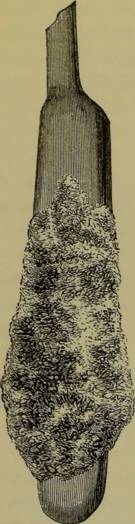 An illustration from Anomalies and curiosities of medicine : being an encyclopedic collection of rare and extraordinary cases, and of the most striking instances of abnormality in all branches of medicine and surgery, derived from an exhaustive research of medical literature from its origin to the present day / abstracted, classified, annotated, and indexed, by George M. Gould and Walter L. Pyle ; with 295 illustrations in the text, and 12 half-tone and colored plates., 1897, leaf 690
