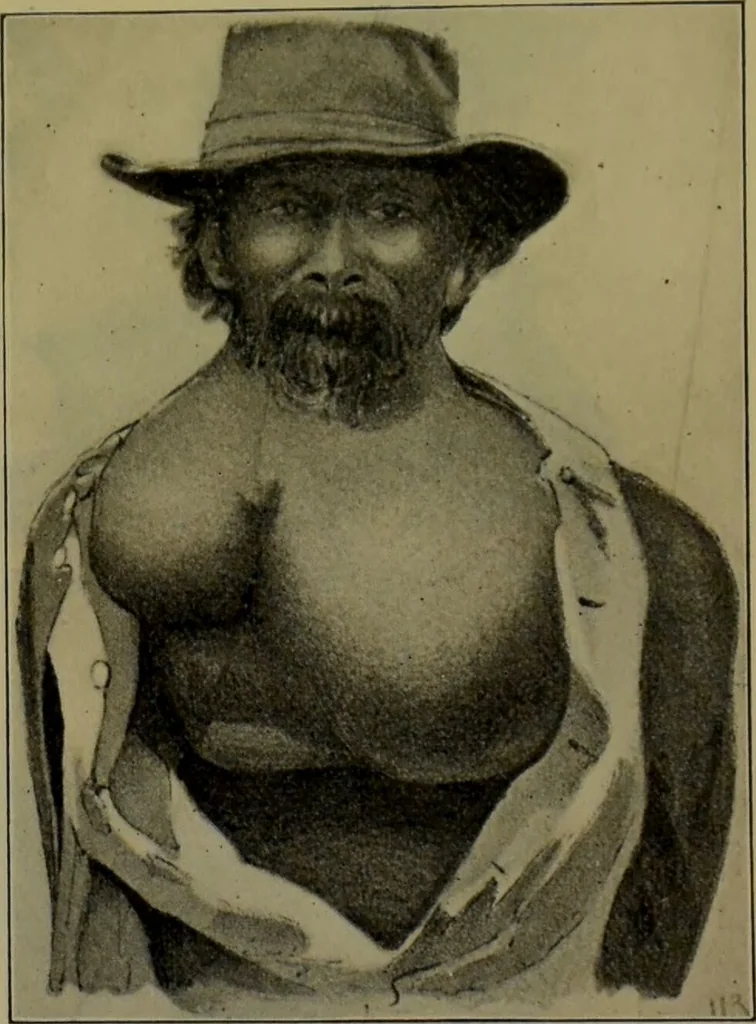 An illustration from Anomalies and curiosities of medicine : being an encyclopedic collection of rare and extraordinary cases, and of the most striking instances of abnormality in all branches of medicine and surgery, derived from an exhaustive research of medical literature from its origin to the present day / abstracted, classified, annotated, and indexed, by George M. Gould and Walter L. Pyle ; with 295 illustrations in the text, and 12 half-tone and colored plates., 1897, leaf 773