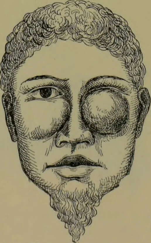 An illustration from Anomalies and curiosities of medicine : being an encyclopedic collection of rare and extraordinary cases, and of the most striking instances of abnormality in all branches of medicine and surgery, derived from an exhaustive research of medical literature from its origin to the present day / abstracted, classified, annotated, and indexed, by George M. Gould and Walter L. Pyle ; with 295 illustrations in the text, and 12 half-tone and colored plates., 1897, leaf 781