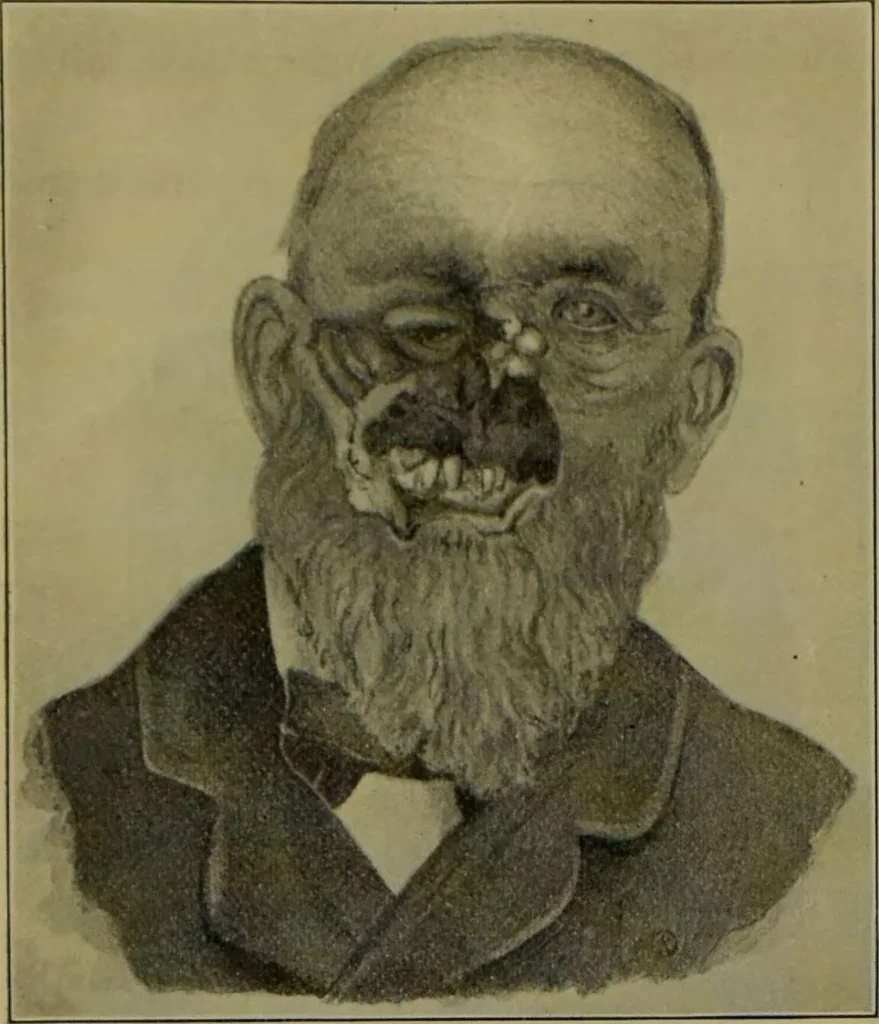 An illustration from Anomalies and curiosities of medicine : being an encyclopedic collection of rare and extraordinary cases, and of the most striking instances of abnormality in all branches of medicine and surgery, derived from an exhaustive research of medical literature from its origin to the present day / abstracted, classified, annotated, and indexed, by George M. Gould and Walter L. Pyle ; with 295 illustrations in the text, and 12 half-tone and colored plates., 1897, leaf 784