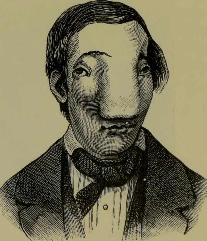 An illustration from Anomalies and curiosities of medicine : being an encyclopedic collection of rare and extraordinary cases, and of the most striking instances of abnormality in all branches of medicine and surgery, derived from an exhaustive research of medical literature from its origin to the present day / abstracted, classified, annotated, and indexed, by George M. Gould and Walter L. Pyle ; with 295 illustrations in the text, and 12 half-tone and colored plates., 1897, leaf 784