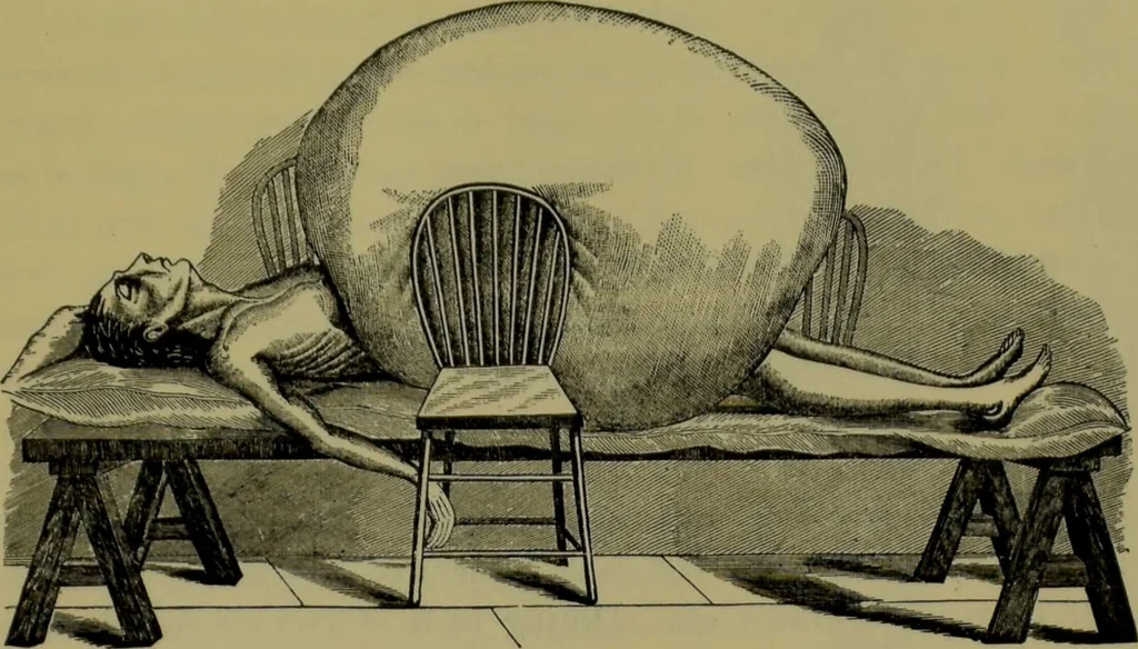 An illustration from Anomalies and curiosities of medicine : being an encyclopedic collection of rare and extraordinary cases, and of the most striking instances of abnormality in all branches of medicine and surgery, derived from an exhaustive research of medical literature from its origin to the present day / abstracted, classified, annotated, and indexed, by George M. Gould and Walter L. Pyle ; with 295 illustrations in the text, and 12 half-tone and colored plates., 1897, leaf 797