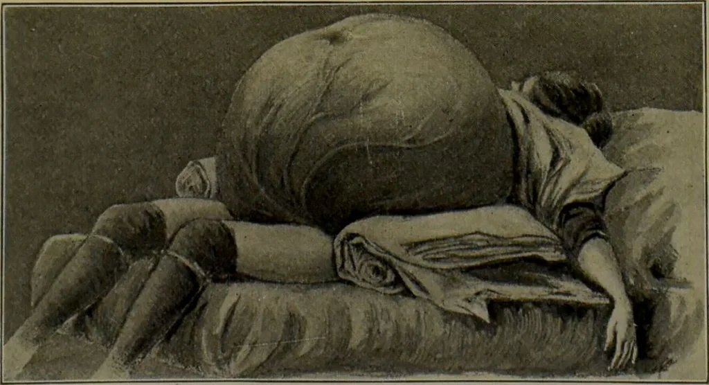 An illustration from Anomalies and curiosities of medicine : being an encyclopedic collection of rare and extraordinary cases, and of the most striking instances of abnormality in all branches of medicine and surgery, derived from an exhaustive research of medical literature from its origin to the present day / abstracted, classified, annotated, and indexed, by George M. Gould and Walter L. Pyle ; with 295 illustrations in the text, and 12 half-tone and colored plates., 1897, leaf 797