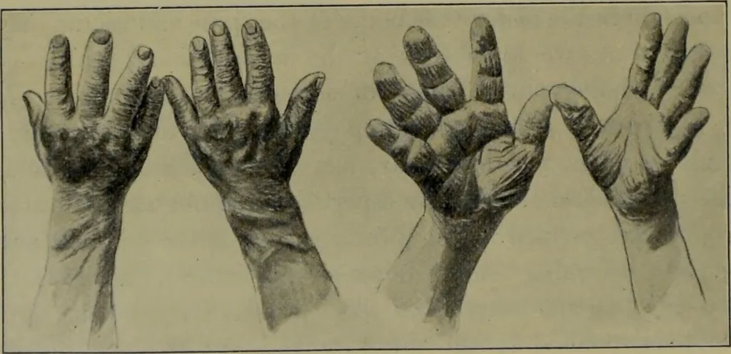 An illustration from Anomalies and curiosities of medicine : being an encyclopedic collection of rare and extraordinary cases, and of the most striking instances of abnormality in all branches of medicine and surgery, derived from an exhaustive research of medical literature from its origin to the present day / abstracted, classified, annotated, and indexed, by George M. Gould and Walter L. Pyle ; with 295 illustrations in the text, and 12 half-tone and colored plates., 1897, leaf 816