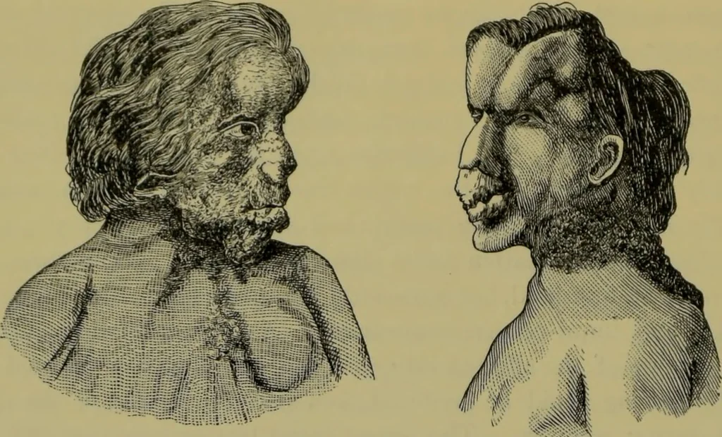 An illustration from Anomalies and curiosities of medicine : being an encyclopedic collection of rare and extraordinary cases, and of the most striking instances of abnormality in all branches of medicine and surgery, derived from an exhaustive research of medical literature from its origin to the present day / abstracted, classified, annotated, and indexed, by George M. Gould and Walter L. Pyle ; with 295 illustrations in the text, and 12 half-tone and colored plates., 1897, leaf 840