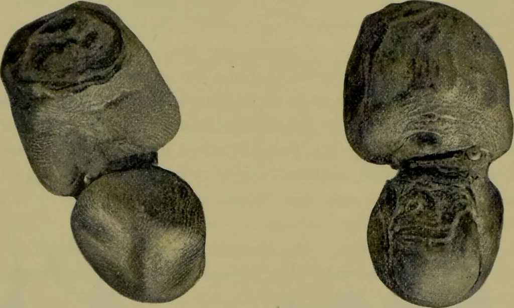 An illustration from Anomalies and curiosities of medicine : being an encyclopedic collection of rare and extraordinary cases, and of the most striking instances of abnormality in all branches of medicine and surgery, derived from an exhaustive research of medical literature from its origin to the present day / abstracted, classified, annotated, and indexed, by George M. Gould and Walter L. Pyle ; with 295 illustrations in the text, and 12 half-tone and colored plates., 1897, leaf 842