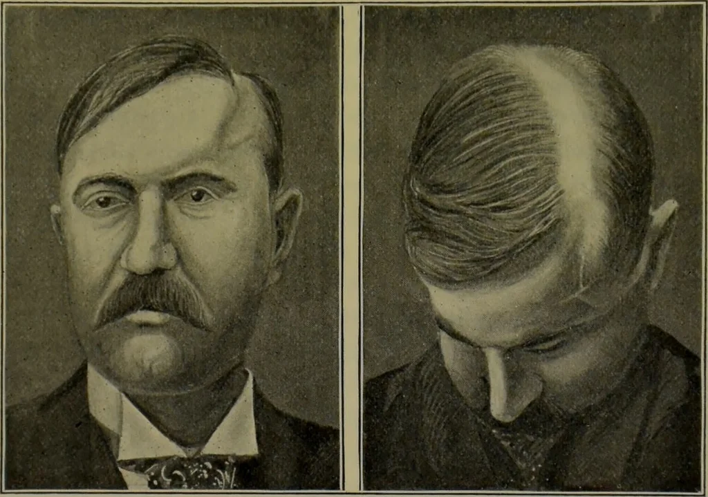An illustration from Anomalies and curiosities of medicine : being an encyclopedic collection of rare and extraordinary cases, and of the most striking instances of abnormality in all branches of medicine and surgery, derived from an exhaustive research of medical literature from its origin to the present day / abstracted, classified, annotated, and indexed, by George M. Gould and Walter L. Pyle ; with 295 illustrations in the text, and 12 half-tone and colored plates., 1897, leaf 873