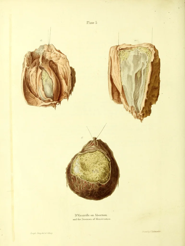 An illustration from Graphic illustrations of abortion and the diseases of menstruation. Consisting of twelve plates from drawings engraved on stone, and coloured by Mr. J. Perry, and two copperplates from the Philosophical transactions, coloured by the same artist. The whole representing forty-five specimens of aborted ova and adventitious productions of the uterus, with preliminary observations, explanations of the figures, and remarks, anatomical physiological / by A.B. Granville., 1834, leaf 60