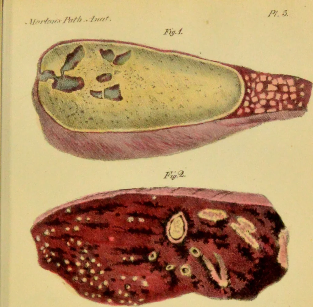 An illustration from Illustrations of pulmonary consumption, its anatomical characters, causes, symptoms and treatment. With twelve plates, drawn and coloured from nature / by Samuel George Morton., 1834, leaf 197