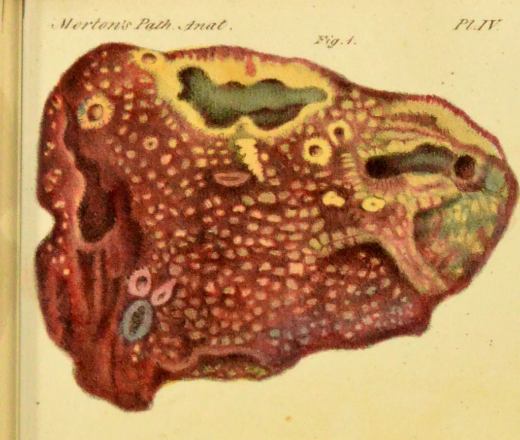 An illustration from Illustrations of pulmonary consumption, its anatomical characters, causes, symptoms and treatment. With twelve plates, drawn and coloured from nature / by Samuel George Morton., 1834, leaf 199