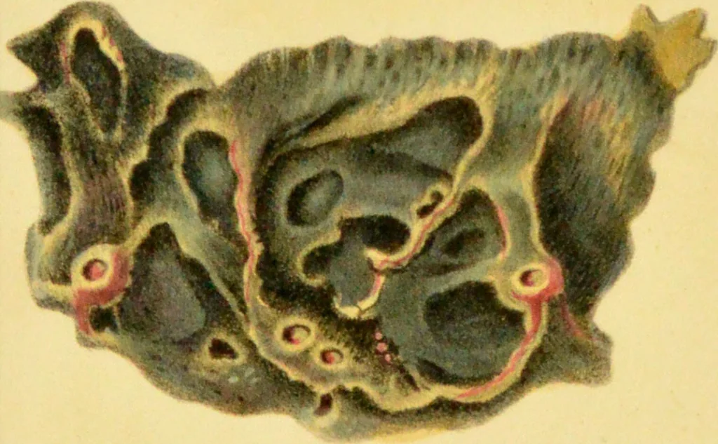 An illustration from Illustrations of pulmonary consumption, its anatomical characters, causes, symptoms and treatment. With twelve plates, drawn and coloured from nature / by Samuel George Morton., 1834, leaf 199