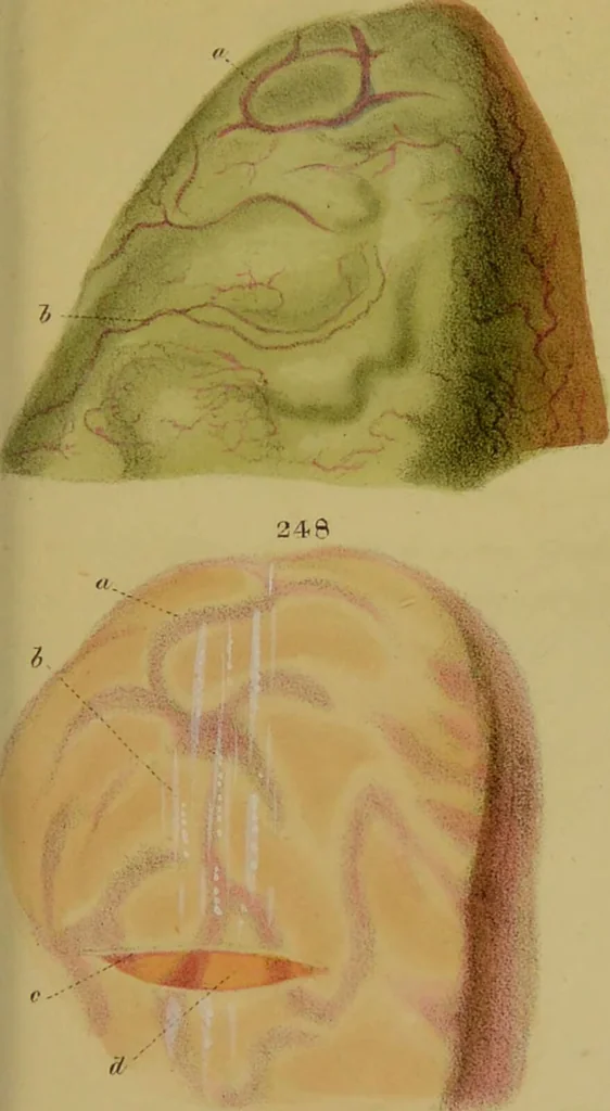 An illustration from Principles and illustrations of morbid anatomy : adapted to the elements of M. Andral, and to the Cyclopaedia of practical medicine, being a complete series of coloured lithographic drawings from originals by the author; with descriptions and summary allusions to cases, symptoms, treatment, &c. ... / by J. Hope., 1834, leaf 593