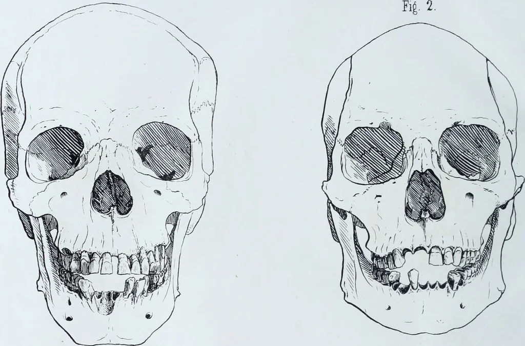 An illustration from Zur Morphologie der Rassen-Schädel : einleitende Bemerkungen und Beiträge, ein Sendschreiben an ... Carl Ernst v. Baer / von Joh. Christ. Gustav Lucae., 1861, leaf 140