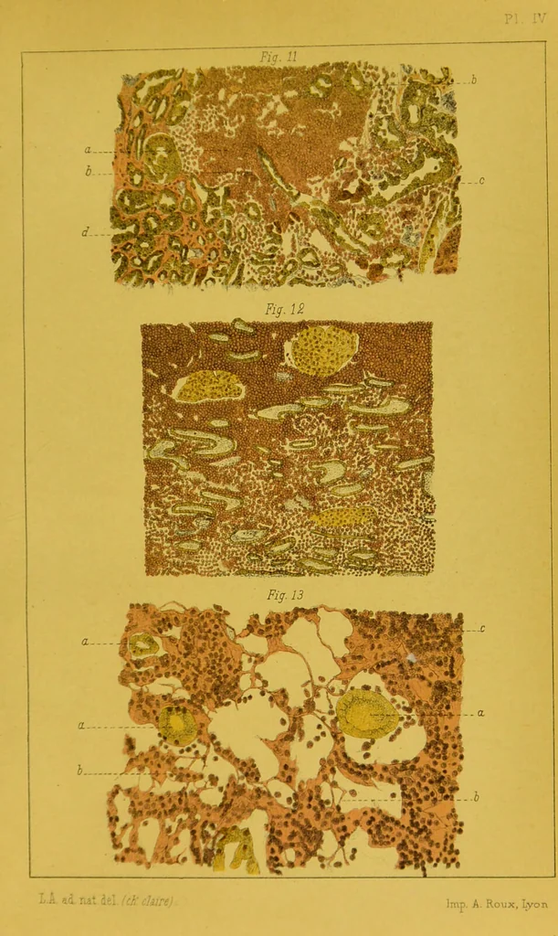 An illustration from Étude du processus histologique des néphrites / par Ch. Hortolès ; avec quatre gravures dans le texte et cinq planches chromolithographiées par M. Gouget., 1881, leaf 199