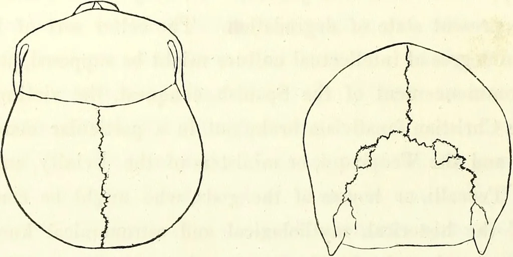 An illustration from Crania americana or, A comparative view of the skulls of various aboriginal nations of North and South America : to which is prefixed an essay on the varities of the human species / by Samuel George Morton., 1839, leaf 174