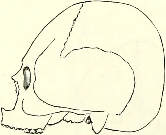 An illustration from Crania americana or, A comparative view of the skulls of various aboriginal nations of North and South America : to which is prefixed an essay on the varities of the human species / by Samuel George Morton., 1839, leaf 176