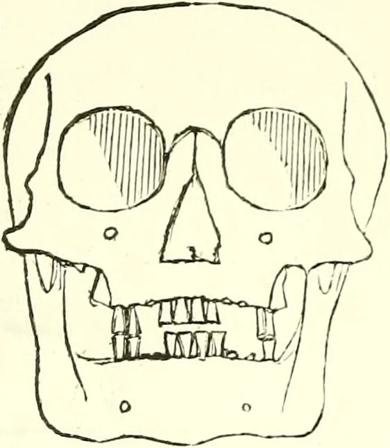 An illustration from Crania americana or, A comparative view of the skulls of various aboriginal nations of North and South America : to which is prefixed an essay on the varities of the human species / by Samuel George Morton., 1839, leaf 235