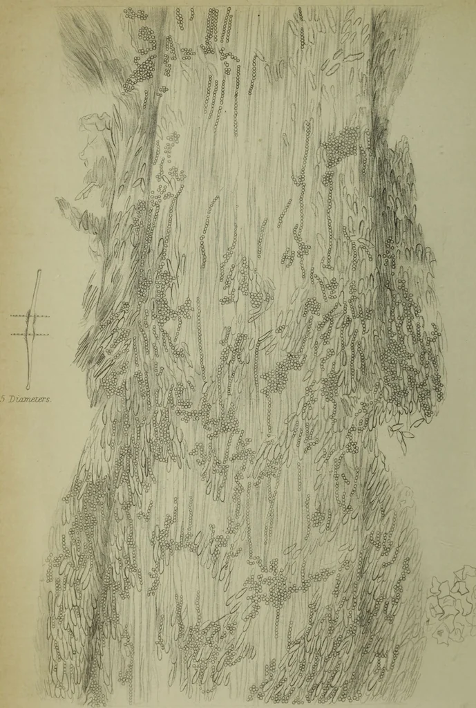An illustration from A treatise on diseases of the skin with special reference to their diagnosis and treatment : including an analysis of 12,000 consecutive cases / Thomas McCall Anderson., 1894, leaf 10