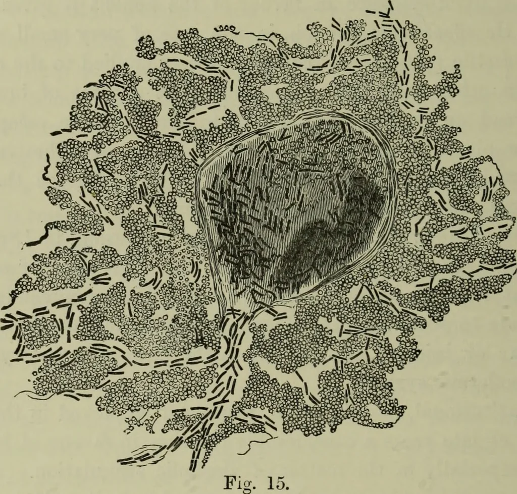 An illustration from A treatise on diseases of the skin with special reference to their diagnosis and treatment : including an analysis of 12,000 consecutive cases / Thomas McCall Anderson., 1894, leaf 374