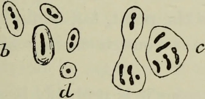 An illustration from A treatise on diseases of the skin with special reference to their diagnosis and treatment : including an analysis of 12,000 consecutive cases / Thomas McCall Anderson., 1894, leaf 479