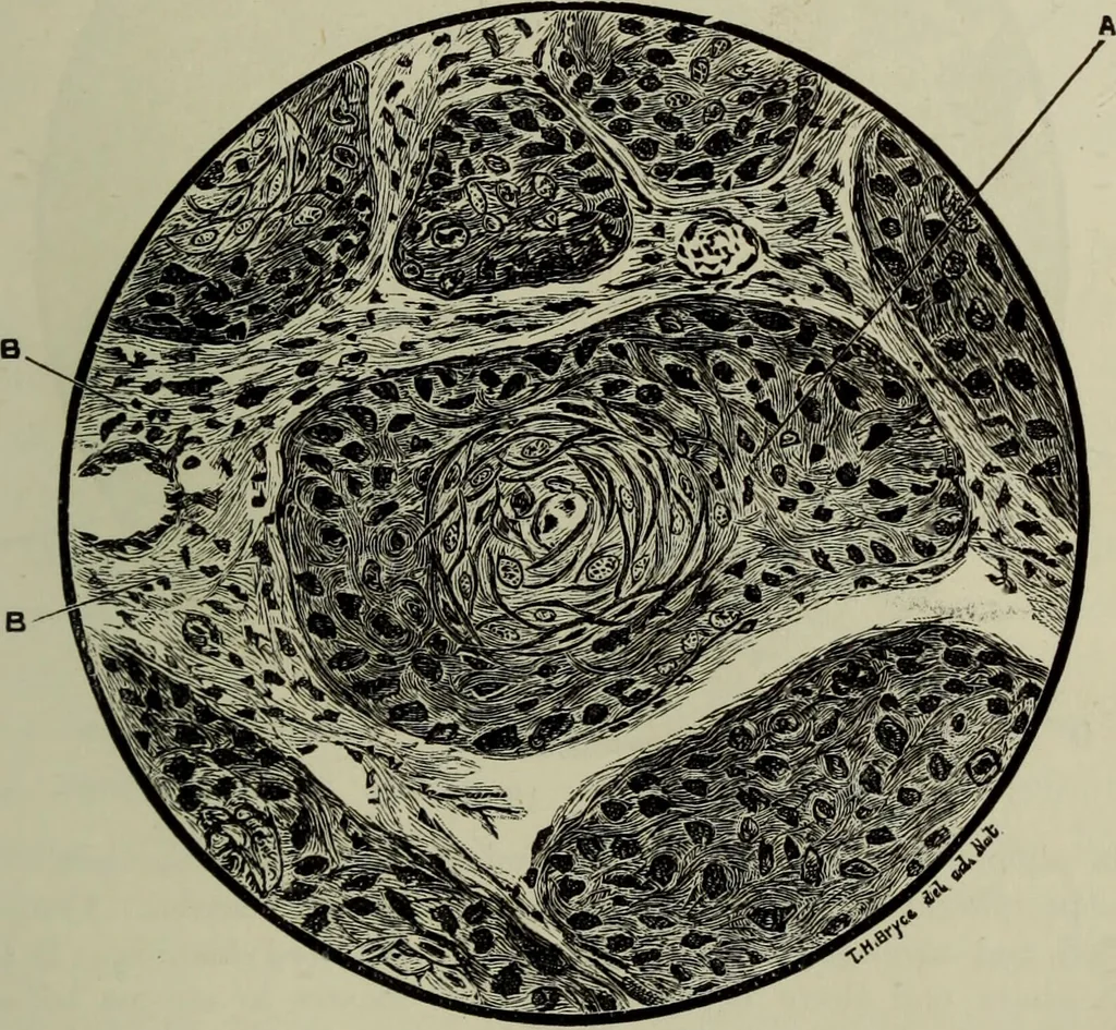 An illustration from A treatise on diseases of the skin with special reference to their diagnosis and treatment : including an analysis of 12,000 consecutive cases / Thomas McCall Anderson., 1894, leaf 485
