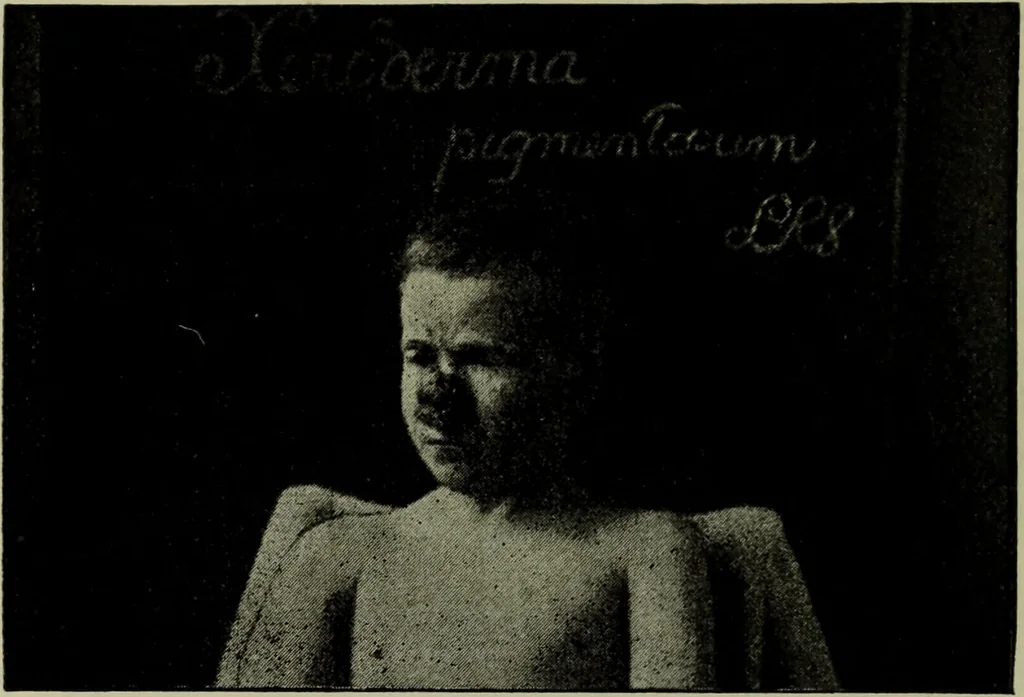 An illustration from A treatise on diseases of the skin with special reference to their diagnosis and treatment : including an analysis of 12,000 consecutive cases / Thomas McCall Anderson., 1894, leaf 488