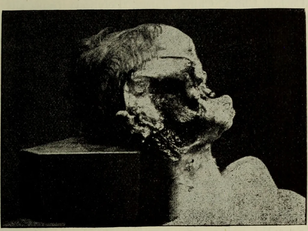 An illustration from A treatise on diseases of the skin with special reference to their diagnosis and treatment : including an analysis of 12,000 consecutive cases / Thomas McCall Anderson., 1894, leaf 489
