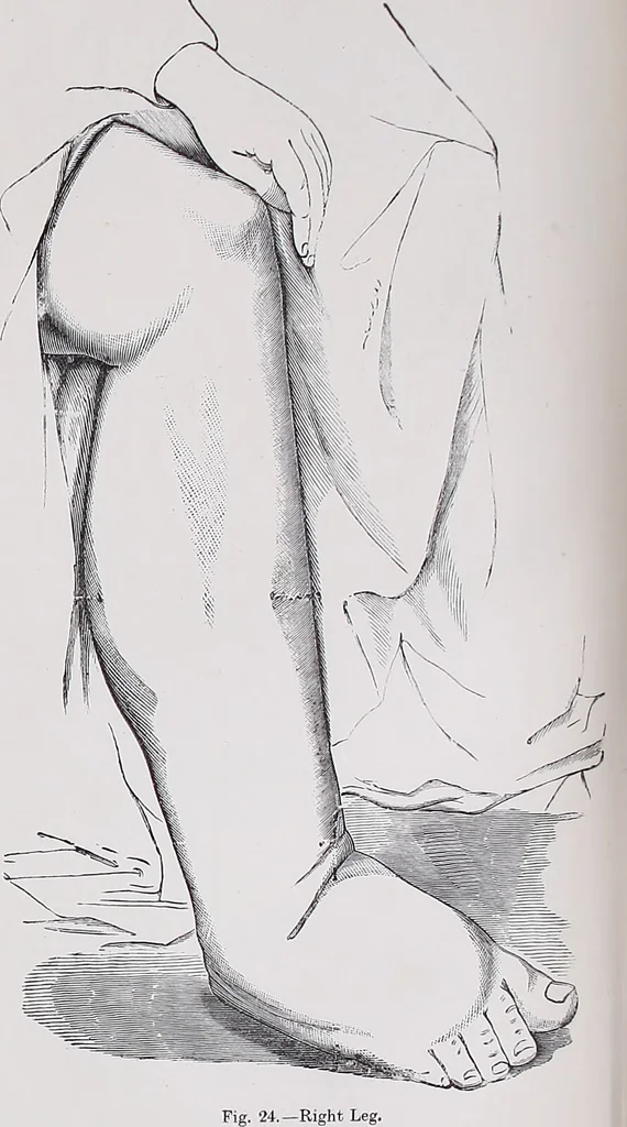 An illustration from A treatise on diseases of the skin with special reference to their diagnosis and treatment : including an analysis of 12,000 consecutive cases / Thomas McCall Anderson., 1894, leaf 496
