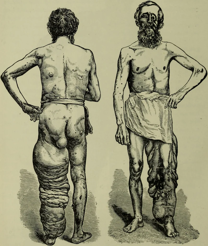 An illustration from A treatise on diseases of the skin with special reference to their diagnosis and treatment : including an analysis of 12,000 consecutive cases / Thomas McCall Anderson., 1894, leaf 538