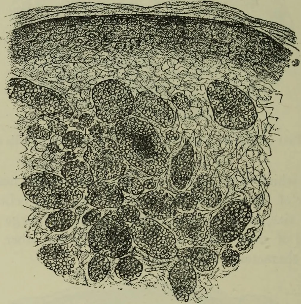An illustration from A treatise on diseases of the skin with special reference to their diagnosis and treatment : including an analysis of 12,000 consecutive cases / Thomas McCall Anderson., 1894, leaf 550