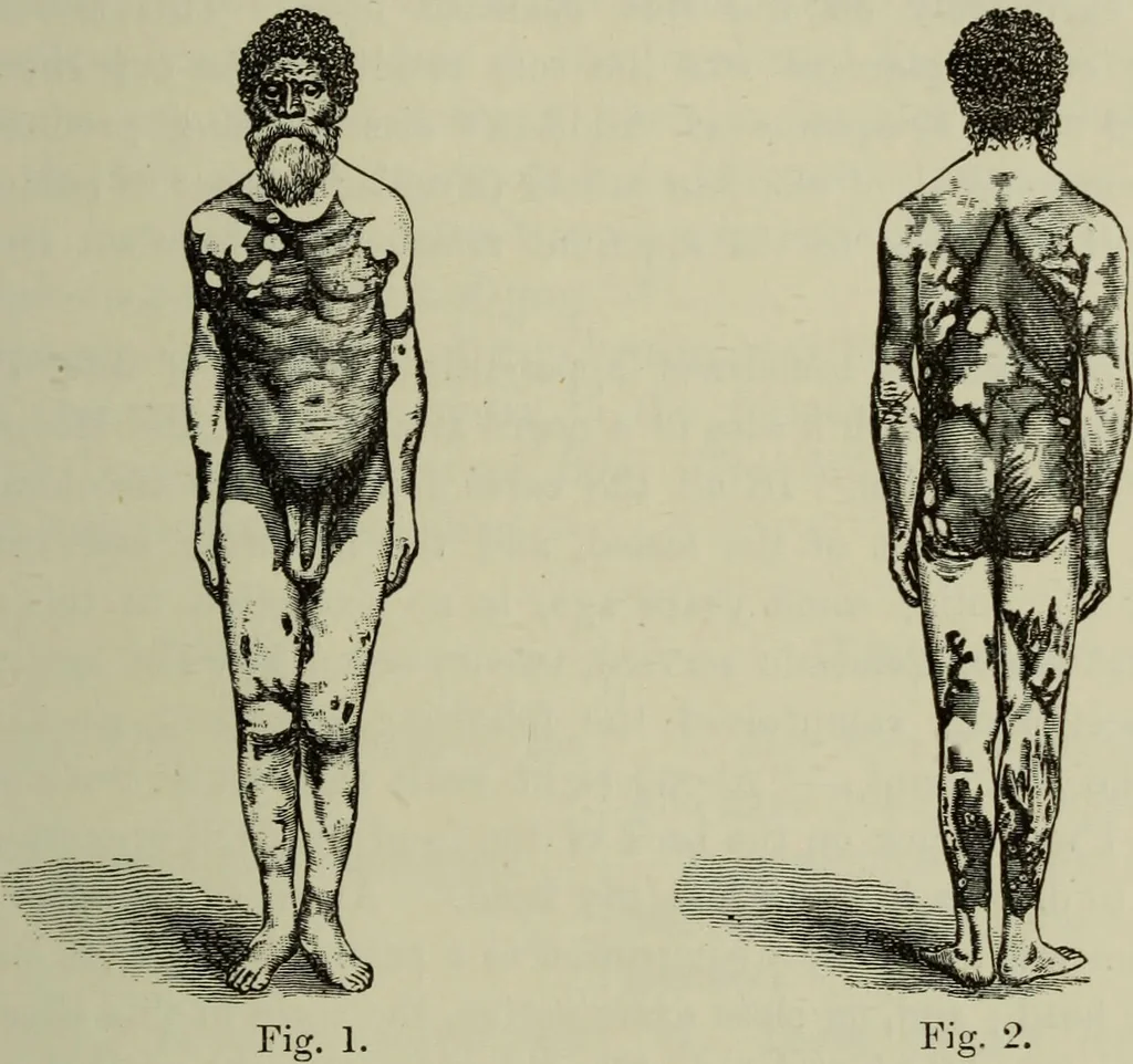 An illustration from A treatise on diseases of the skin with special reference to their diagnosis and treatment : including an analysis of 12,000 consecutive cases / Thomas McCall Anderson., 1894, leaf 59
