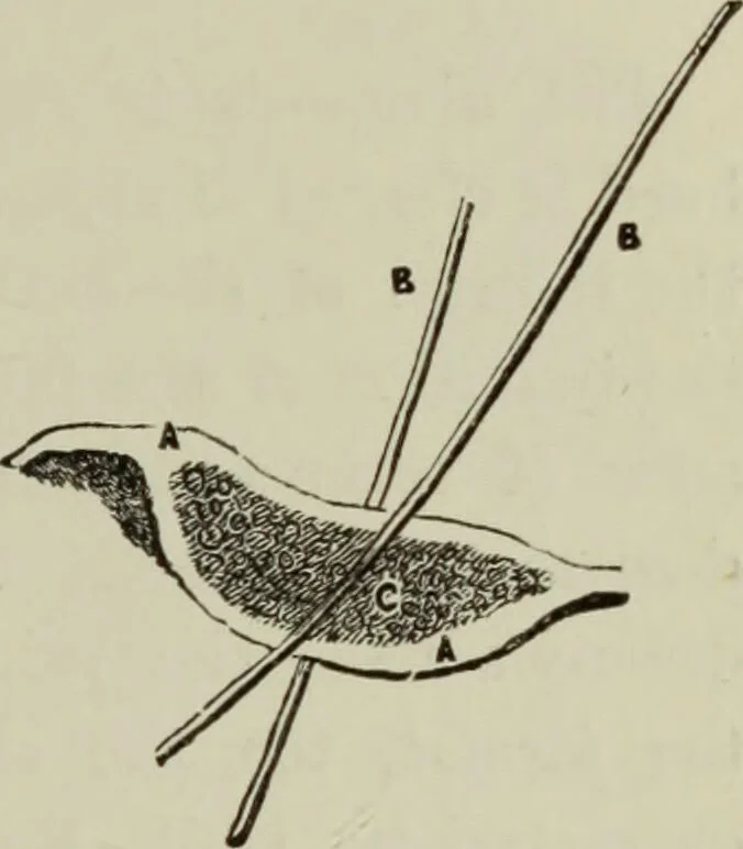 An illustration from A treatise on diseases of the skin with special reference to their diagnosis and treatment : including an analysis of 12,000 consecutive cases / Thomas McCall Anderson., 1894, leaf 597