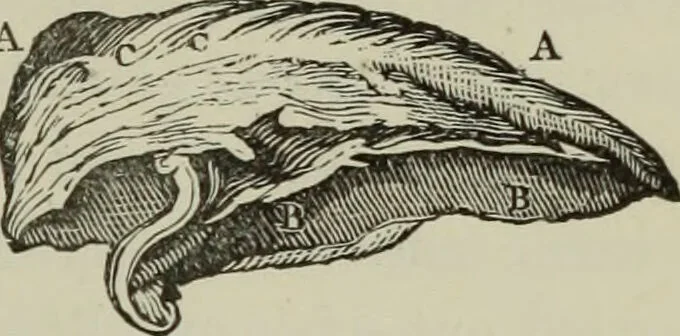 An illustration from A treatise on diseases of the skin with special reference to their diagnosis and treatment : including an analysis of 12,000 consecutive cases / Thomas McCall Anderson., 1894, leaf 601