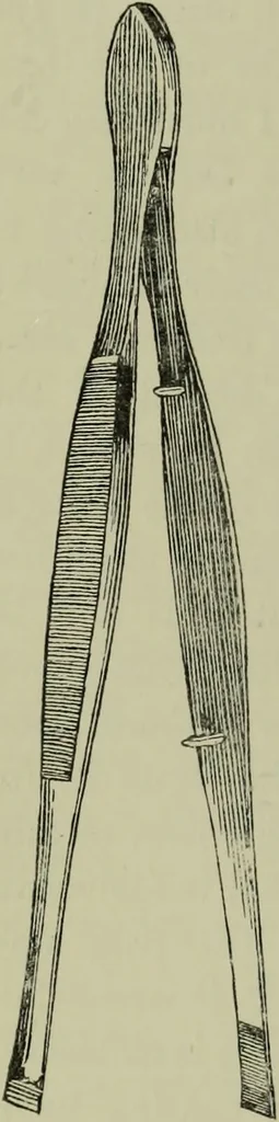 An illustration from A treatise on diseases of the skin with special reference to their diagnosis and treatment : including an analysis of 12,000 consecutive cases / Thomas McCall Anderson., 1894, leaf 604