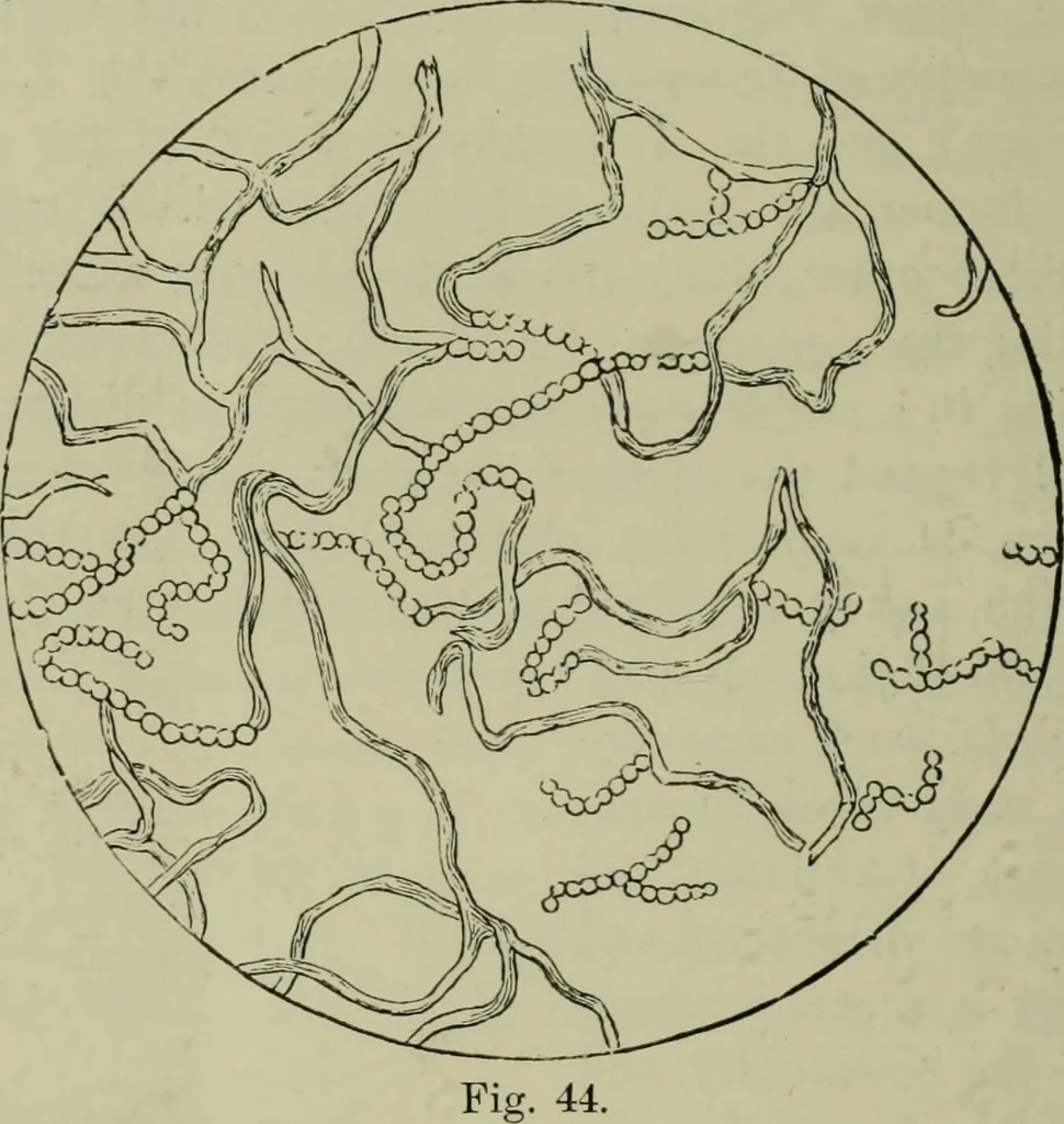 An illustration from A treatise on diseases of the skin with special reference to their diagnosis and treatment : including an analysis of 12,000 consecutive cases / Thomas McCall Anderson., 1894, leaf 612