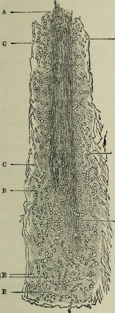 An illustration from A treatise on diseases of the skin with special reference to their diagnosis and treatment : including an analysis of 12,000 consecutive cases / Thomas McCall Anderson., 1894, leaf 613